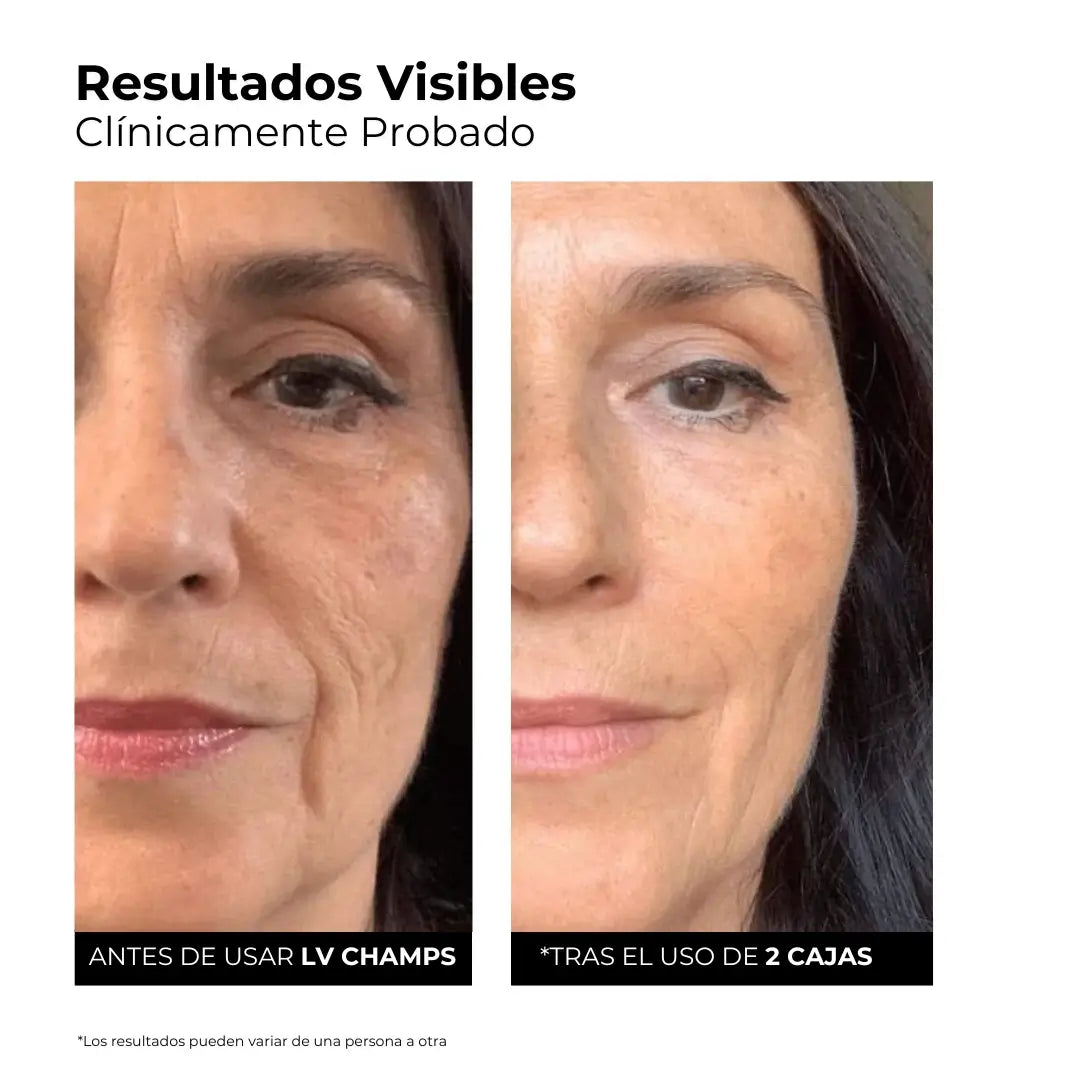 Serum Ultra Hidratante-Reparador con 3% de Ácido Hialurónico de LV Champs (30 Ampollas)