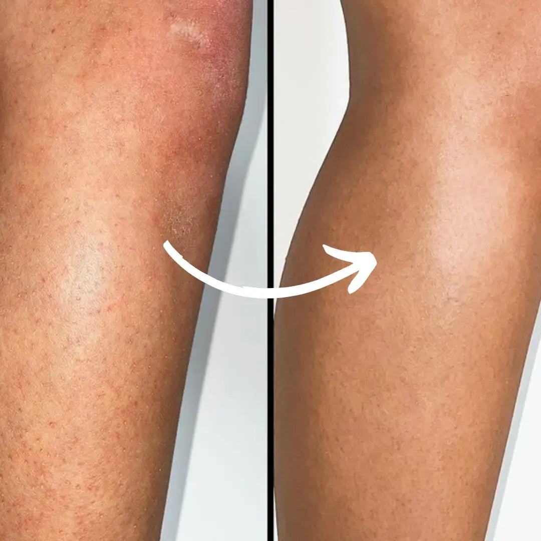 Serum Anti-Vellos Encarnados, Manchas Oscuras/Rojizas y Granitos Con Triple Exfoliación